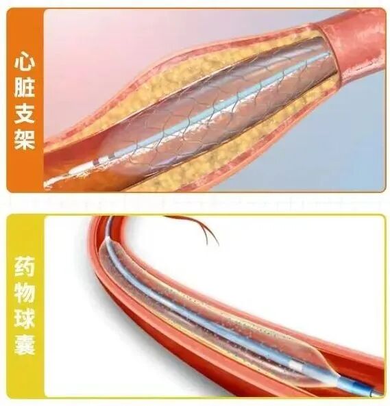 做完心脏支架/药物球囊,血管不再堵?真的可以无拘无束放飞自我吗?