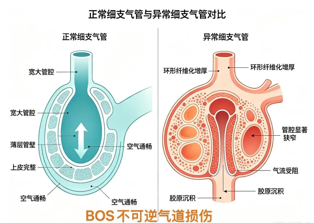造血干细胞移植前,为什么一定要做肺功能检查?