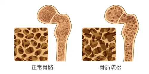 “寂静”的疾病——警惕骨质疏松