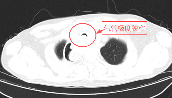 【一医好技术】命悬一线！支气管镜下支架置入让濒临窒息的患者重获顺畅呼吸
