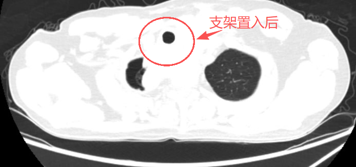 【一医好技术】命悬一线！支气管镜下支架置入让濒临窒息的患者重获顺畅呼吸