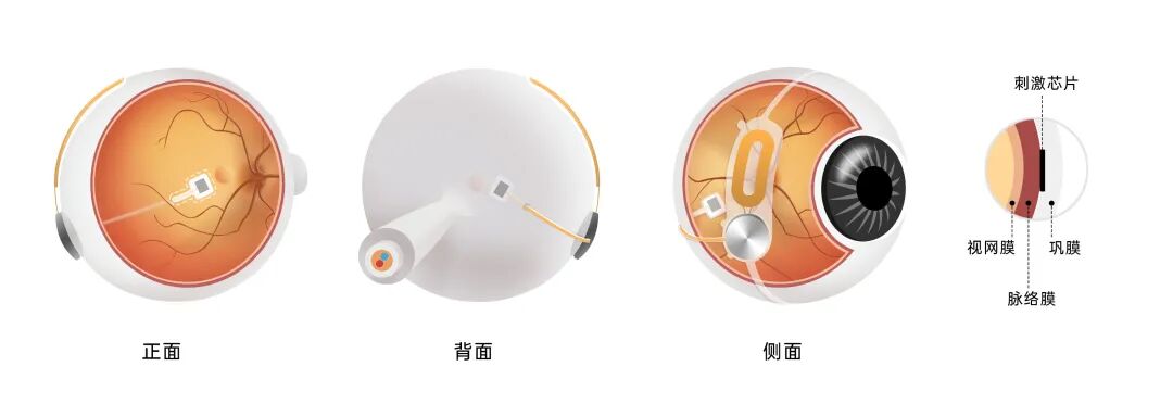 全球首例！半侵入式植入芯片，失明四年的他看见了