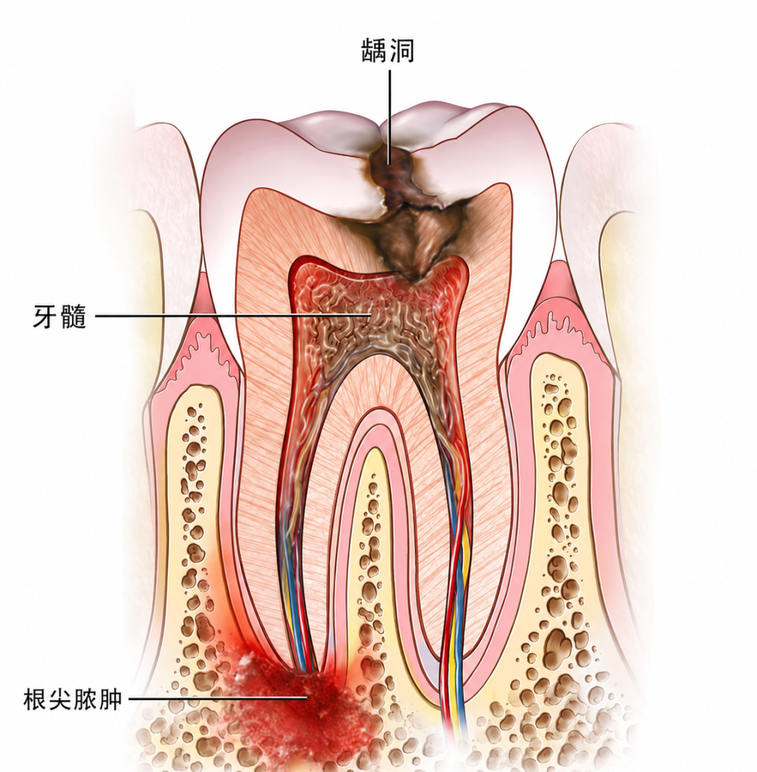 有蛀牙却一点都不疼?“隐形蛀牙”为什么更危险