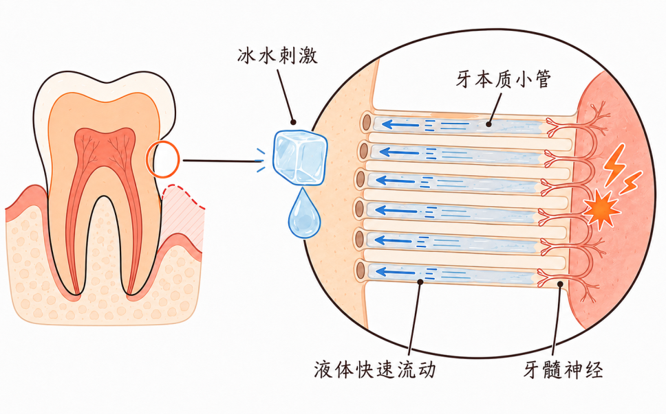 有蛀牙却一点都不疼?“隐形蛀牙”为什么更危险