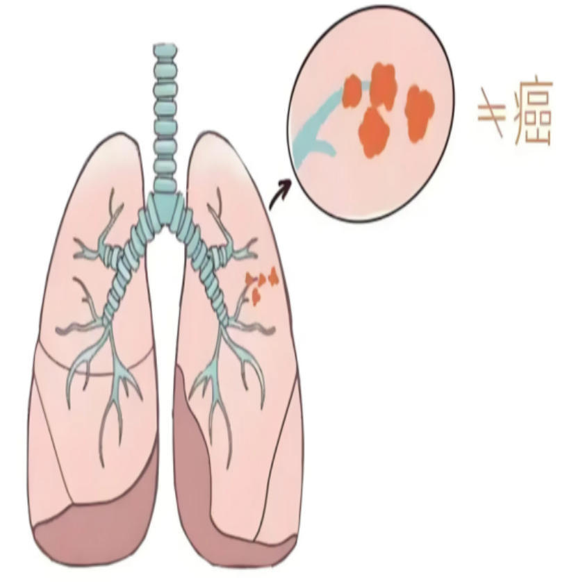 医语辟谣|查出肺结节=迟早变肺癌,必须马上手术……心胸外科八大误区别再被误导