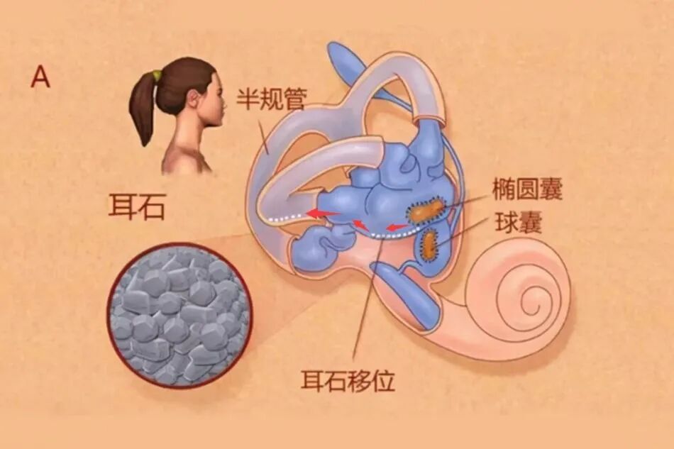 【科普】坐坐“小椅子”就能治眩晕？