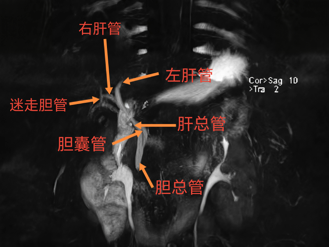 台心医院肝胆胰外科:术前 MRCP 精准导航,守好胆囊手术安全底线