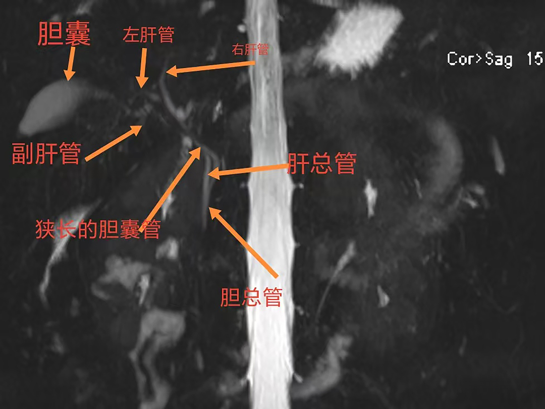 台心医院肝胆胰外科:术前 MRCP 精准导航,守好胆囊手术安全底线