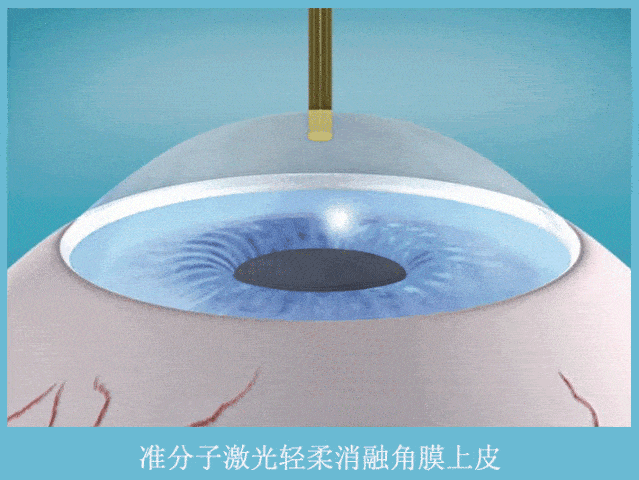 同样是近视手术,为什么别人比我恢复快?