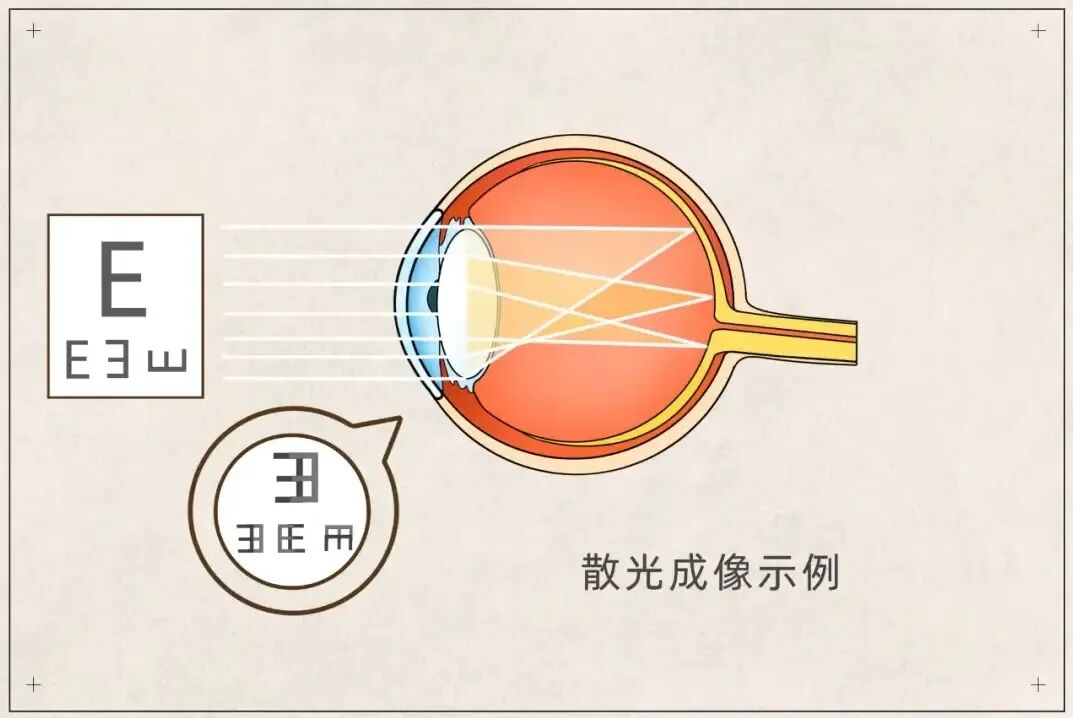 经常侧躺看手机会引起散光?眼科医生:这不是危言耸听