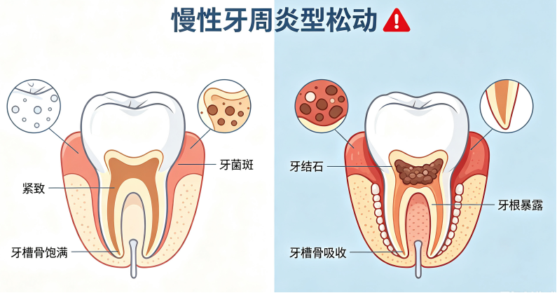 年轻就不怕？牙齿松动可不是老年人专利