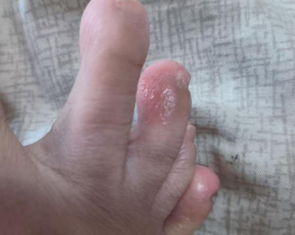 【二附院医生说】手上突然冒出透明小水疱?当心汗疱疹