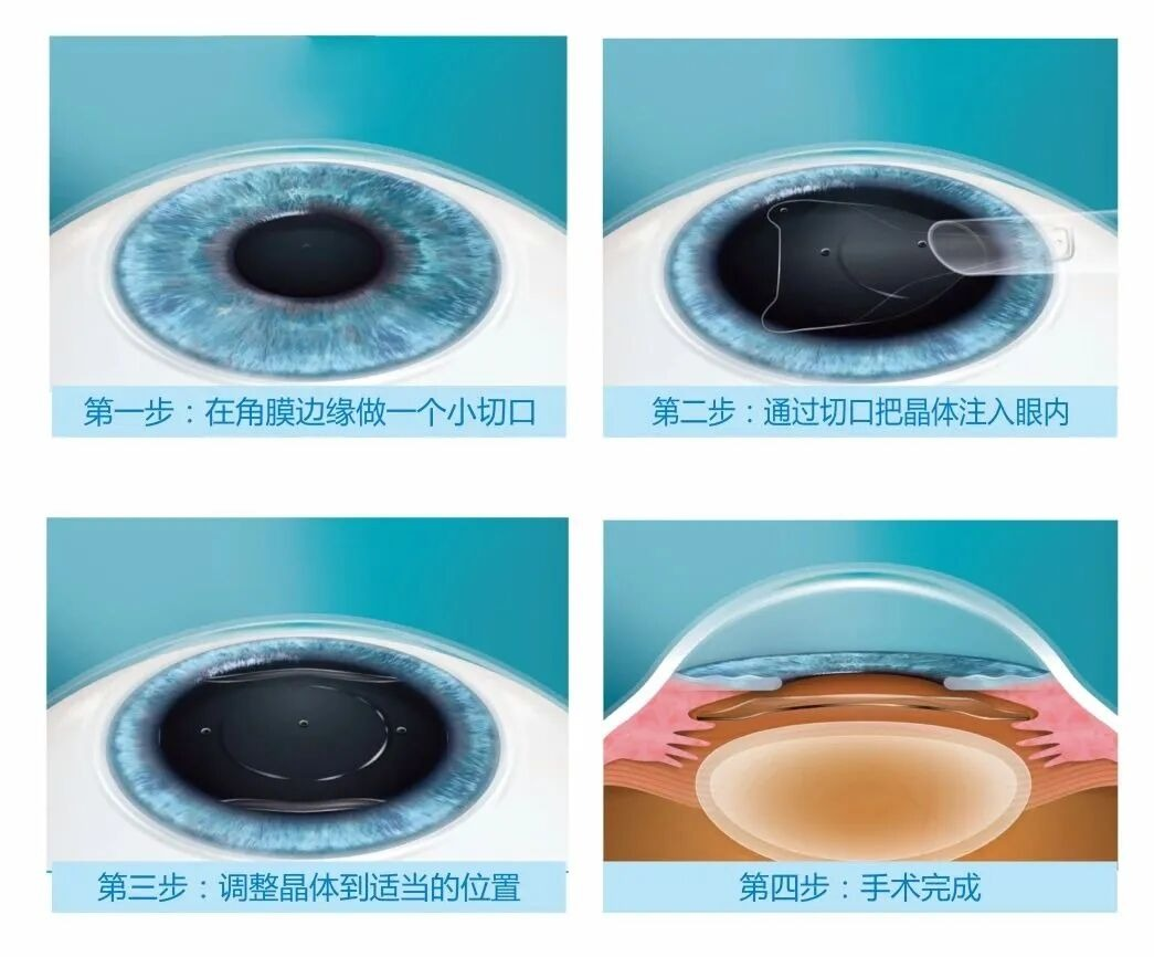 全飞秒、半飞秒、ICL晶体植入应该如何选择?武汉普瑞眼科医院一文帮你理清近视手术术式