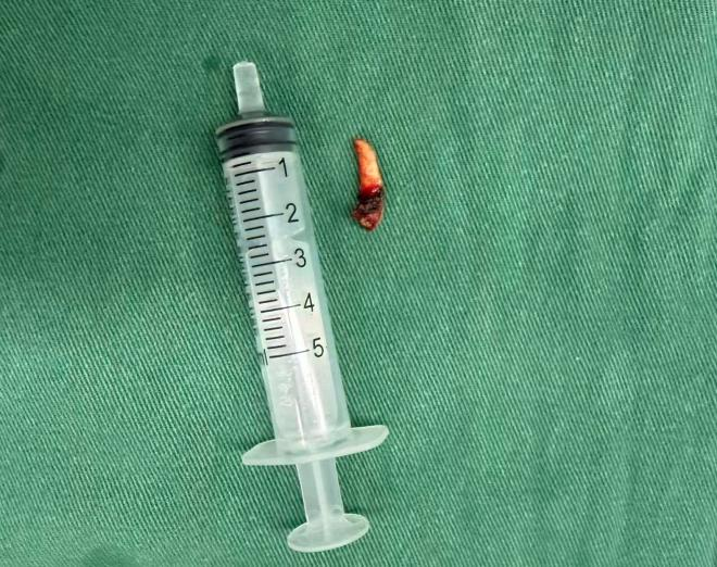 鼻腔里长出一颗“牙”？男子鼻窦炎反复发作6年，病根竟是它