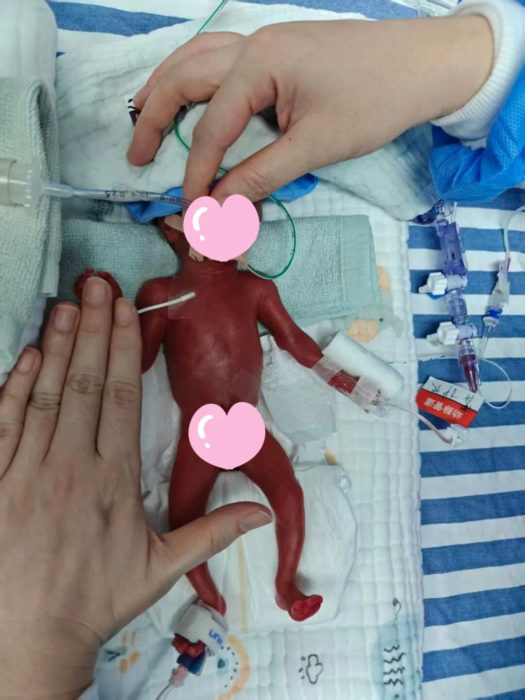 330 克的奇迹！深圳市妇幼保健院成功救治生存极限超早产儿「小泽宝」