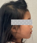 孩子地包天别忽视|国文医院口腔科前方牵引改善骨性颌面问题