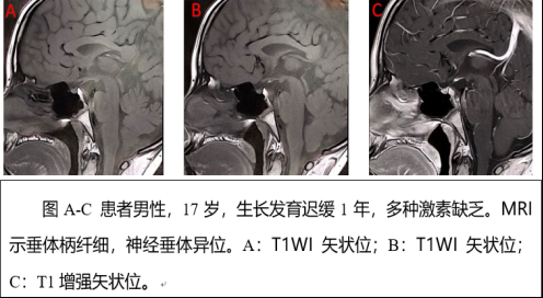 青春期“迟到”了?聊聊垂体柄阻断综合征