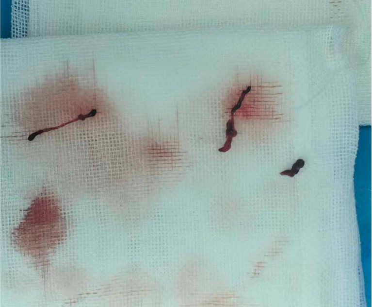 巧通 12 年 「生命桥血管」|国文医院完成搭桥术后桥血管血栓高难度介入治疗