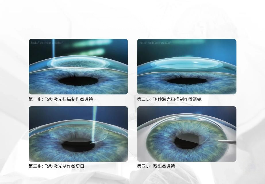 全飞秒、半飞秒、ICL晶体植入应该如何选择?武汉普瑞眼科医院一文帮你理清近视手术术式