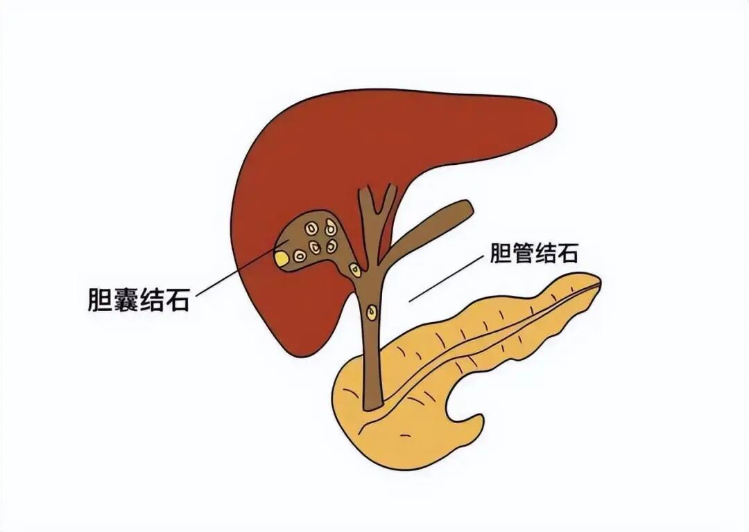 连续3个年轻的胆囊癌患者,让我决定写下这篇文章
