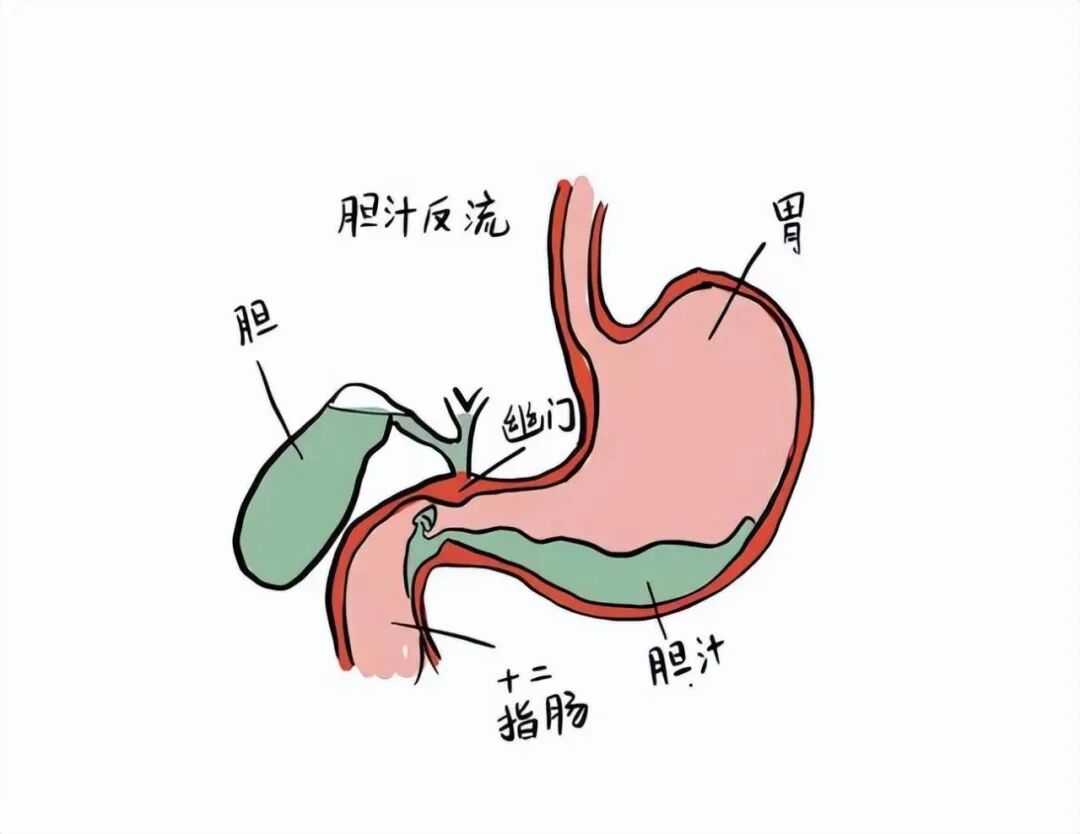 连续3个年轻的胆囊癌患者,让我决定写下这篇文章