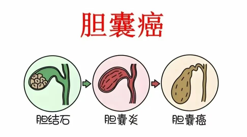 连续3个年轻的胆囊癌患者,让我决定写下这篇文章