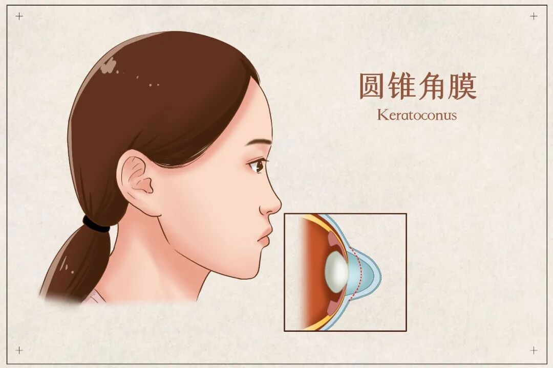 如何识别早期圆锥角膜?这些危害不容忽视!