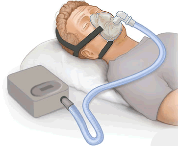 睡觉打鼾憋气、白天总犯困?你该给睡眠做一次“体检”了