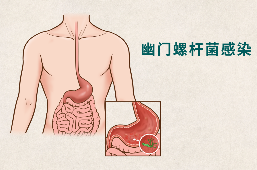 胃总反复不舒服？这项无痛检测，帮您筛查幽门螺杆菌