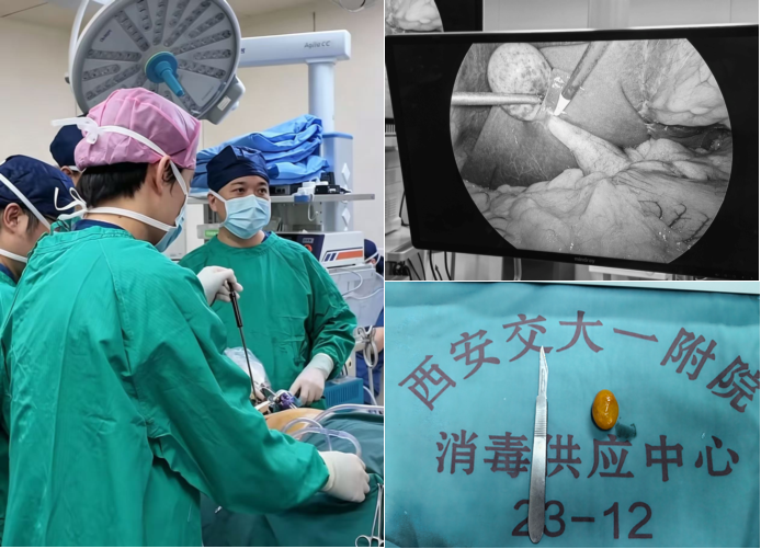 陆港院区腹部外科成功救治六旬危重肝内外胆管结石患者