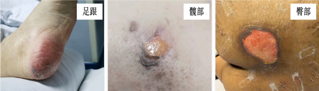 【健康科普】翻身、减压、营养,压疮预防六大核心措施,在家就能做对!