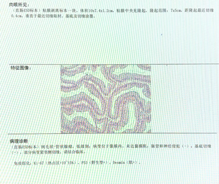 10 cm 巨大肿瘤堵住直肠! 74 岁老人面临「切肛保命」?这支团队用内镜改变结局