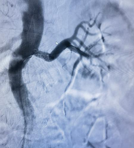 我院 IVUS 辅助肾动脉支架植入术,精准护航血管健康
