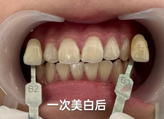 牙黄、牙色斑有救了！真的会变白！