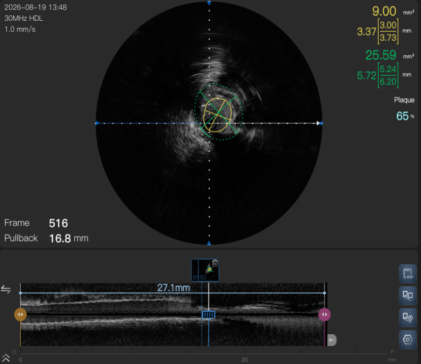 我院 IVUS 辅助肾动脉支架植入术,精准护航血管健康