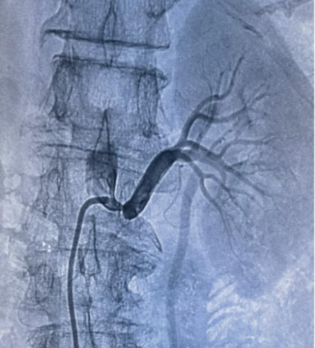 我院 IVUS 辅助肾动脉支架植入术,精准护航血管健康
