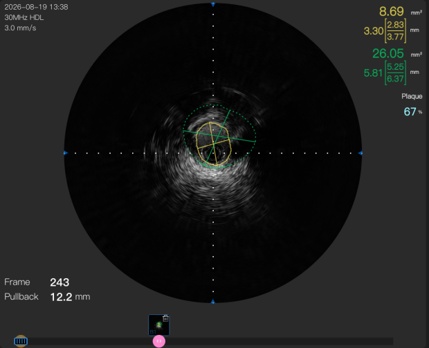 我院 IVUS 辅助肾动脉支架植入术,精准护航血管健康