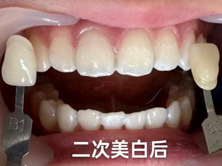 牙黄、牙色斑有救了！真的会变白！