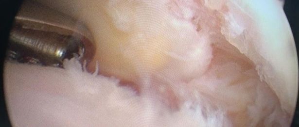 手腕扭伤经久不愈？别让“小损伤”偷走你的手腕健康