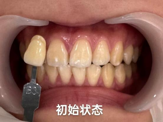 牙黄、牙色斑有救了！真的会变白！