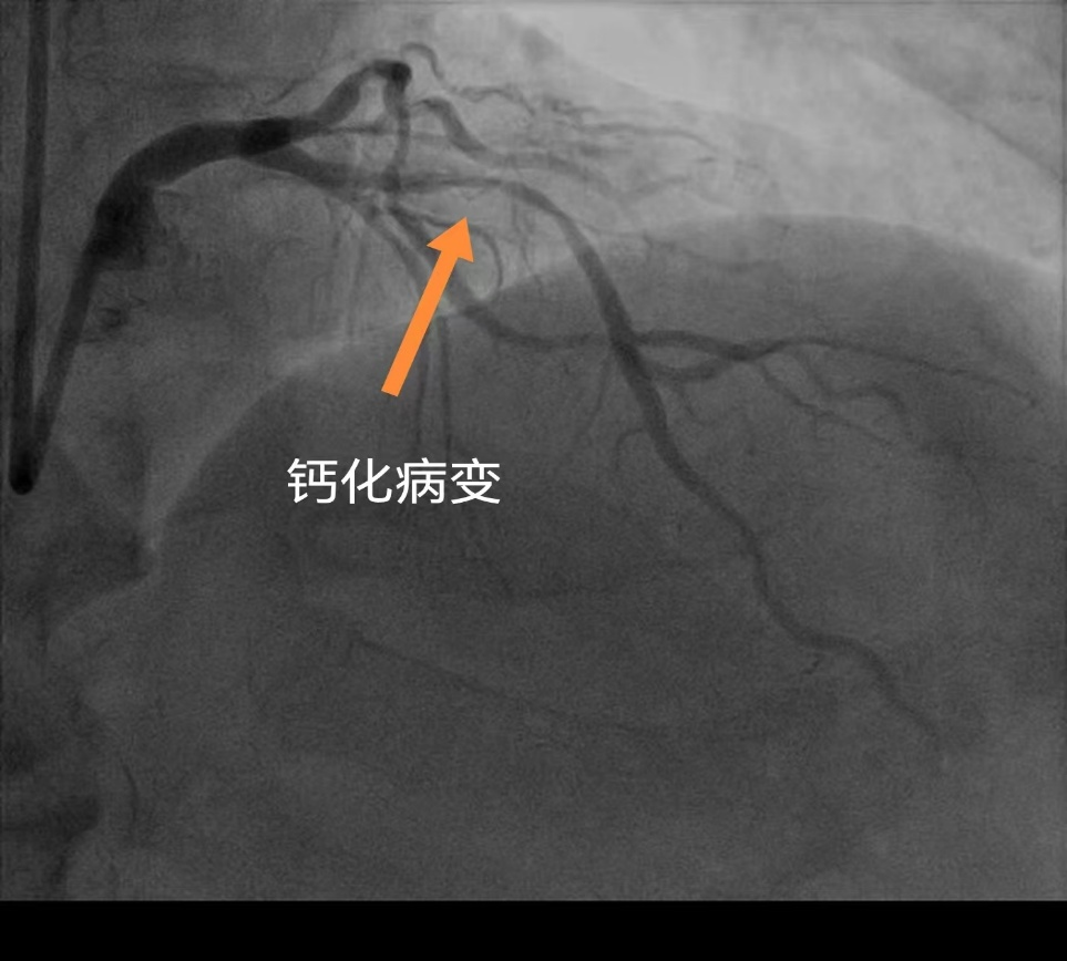 攻坚克难，「磨」砺前行 | 河科大二附院IVUS+旋磨术精准击碎前降支“钙化堡垒”