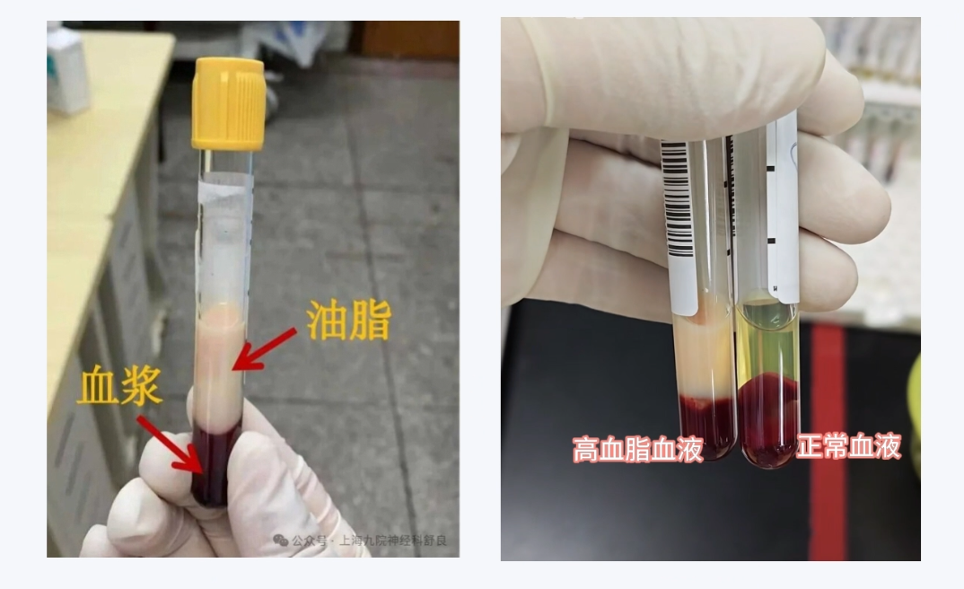 科普丨带你认识血脂家族的“4大核心角色”