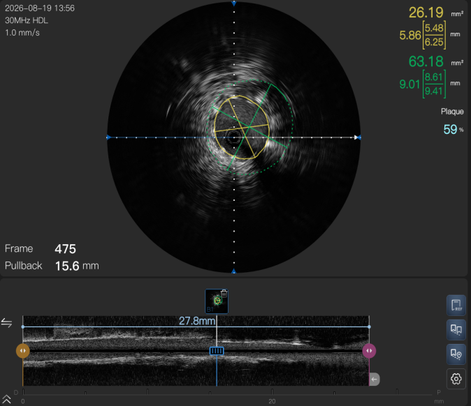 我院 IVUS 辅助肾动脉支架植入术,精准护航血管健康