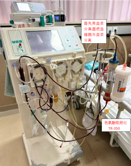 再突破!我院肾内科与神经内科联合开展佛山首例 Immusorba 免疫吸附治疗