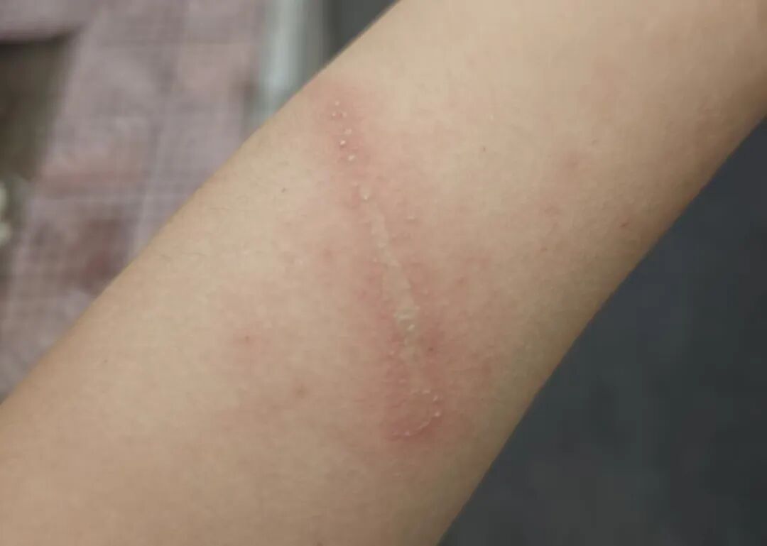 身上落了这个虫，千万别拍！拍了就烂皮肤
