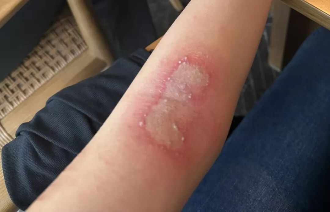 身上落了这个虫，千万别拍！拍了就烂皮肤