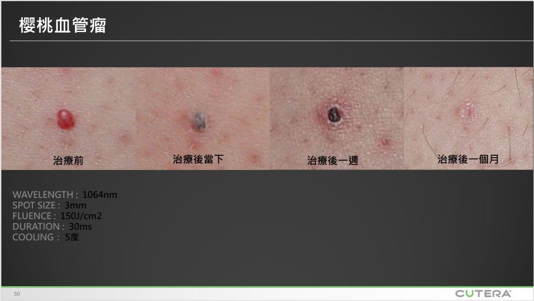 警惕身上的小红点？先分清樱桃痣和蜘蛛痣
