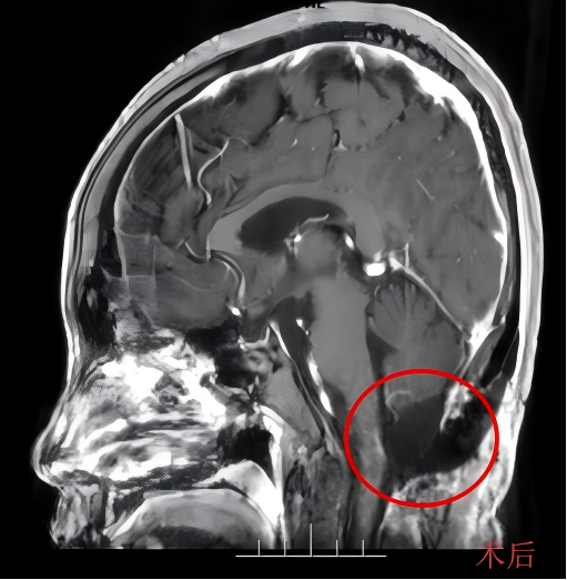 呼吸困难≠肺炎！27 岁青年险遭延髓肿瘤夺命，我院神经外科牵头多学科 MDT 攻克生命「禁区」
