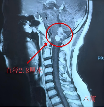 呼吸困难≠肺炎！27 岁青年险遭延髓肿瘤夺命，我院神经外科牵头多学科 MDT 攻克生命「禁区」