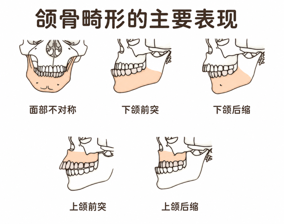 听说拔智齿、做正畸能瘦脸?真有人脸直接小一圈?
